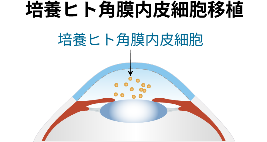 培養ヒト角膜内皮細胞移植